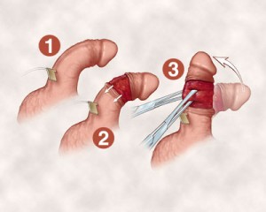 Penis Enlargement with Surgical Method