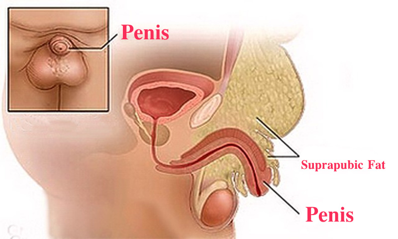 How to increase penis size by reducing fat on the pubis without surgery