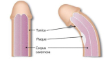 Penis Cuvature – Correction Of Penile Curvature