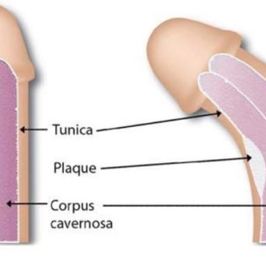 Penis Cuvature – Correction Of Penile Curvature